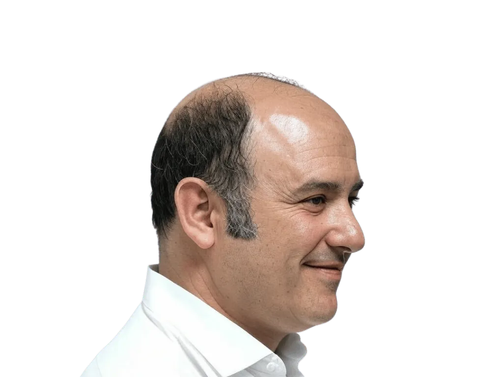 Norwood 7 (Sehr ausgeprägter Haarausfall) Haarausfall Muster - Haartransplantation Dion Hair Clinic