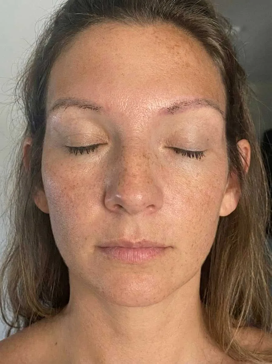 Haartransplantation Vorher Saphir FUE & DHI Hybrid - Patientin 1 Dion Hair Clinic