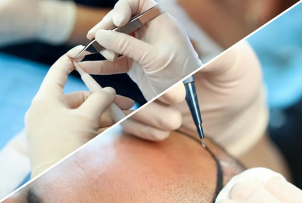 Kombinations-Technik Haartransplantation Methode - Dion Hair Clinic